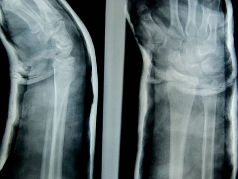 artroza se riješi bolova u zglobovima