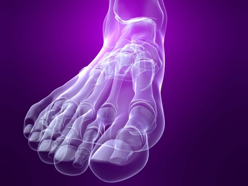 akutna bol u zglobu velikog nožnog prsta solne kupke za liječenje artroze