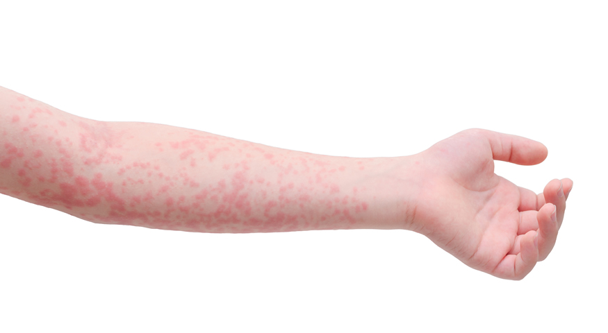 hepatitis u zglobovima bol u području zglobova kuka