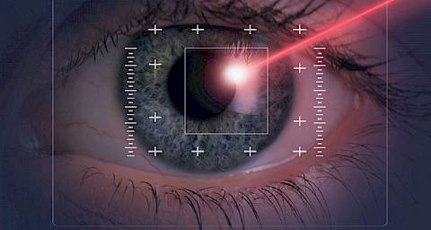 Laser u funkciji dioptrije