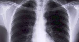 Pneumonije uzrokovane respiratornim virusima 