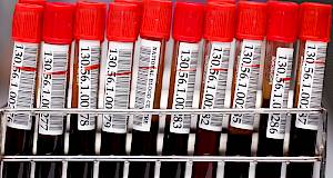 Novi test za dijagnozu anemija