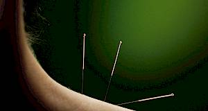 Akupunktura i umjetna oplodnja