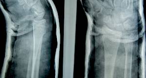 Pacijenti nakon prijeloma kostiju nisu ni svjesni mogućeg rizika od dobivanja osteoporoze
