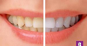 Ovo morate znati ako razmišljate o izbjeljivanju zubi!