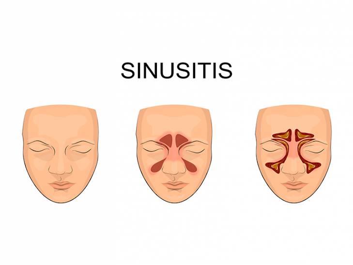 Upala sinusa - kako nastaje sinusitis?