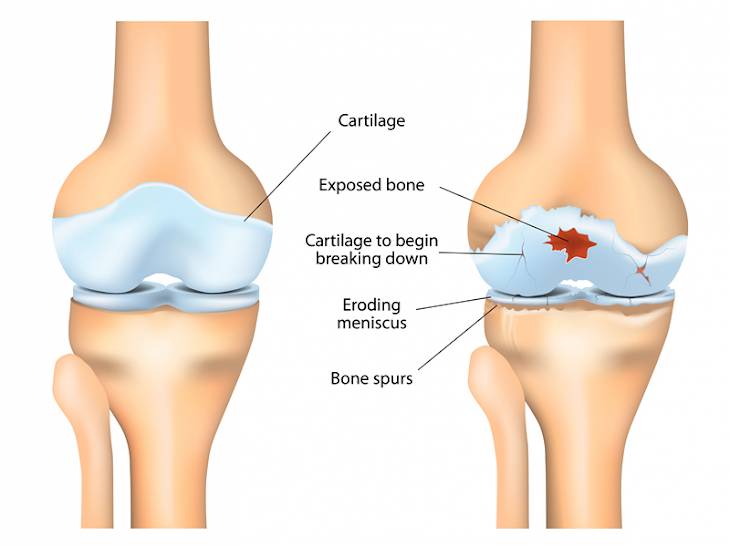 liječenje osteoartritisa od stopala žuči