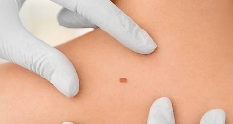Razvijen prvi krvni test za rano otkrivanje melanoma!
