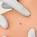 Razvijen prvi krvni test za rano otkrivanje melanoma!