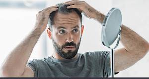 Ispadanje kose kod muškaraca: uzroci i terapija