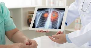 Novo otkriće moglo bi smanjiti broj smrti od raka pluća