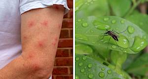 Kako jednostavno i učinkovito ublažiti svrbež na mjestu uboda komarca?