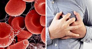 Kako prepoznati da imate krvni ugrušak? Ako ne reagirate na vrijeme, posljedice mogu biti kobne
