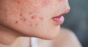 Proširene pore, miteseri, akne... Dermatologinja otkriva kako riješiti 6 najčešćih problema s kožom