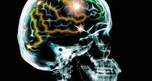 Imaju li autisti previše sinapsi u mozgu?