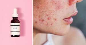 Pomaže li retinol kod akni i kako ga pravilno koristiti?