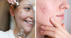 Pomaže li retinol kod akni i kako ga pravilno koristiti