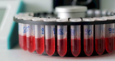 CA 125 test