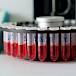 CA 125 test